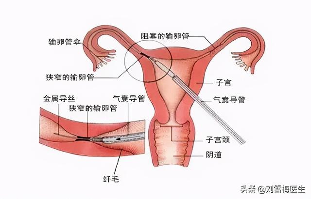 输卵管试管婴儿 输卵管试管婴儿