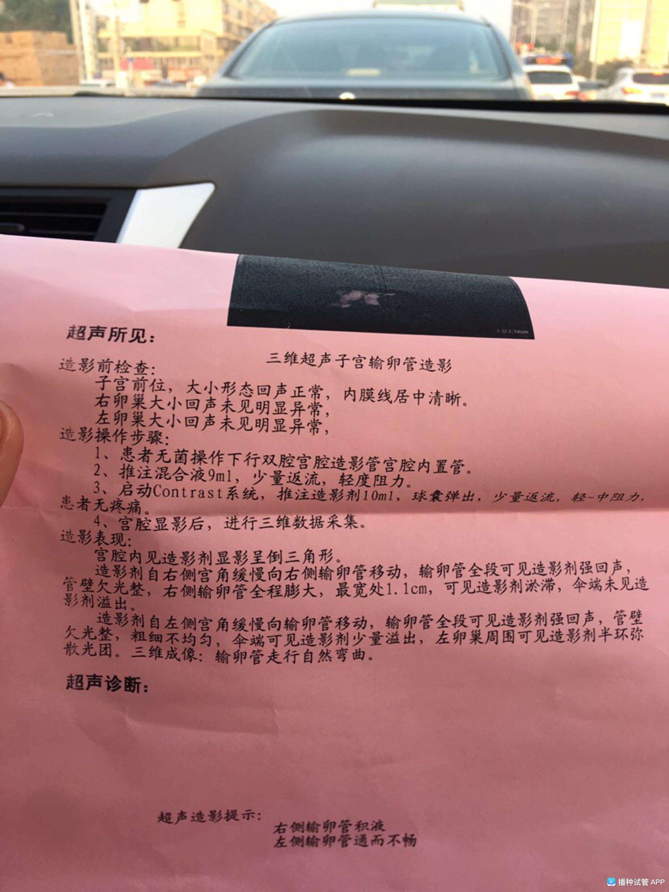 试管婴儿起针试管婴儿打针取卵过程
