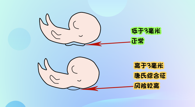 试管婴儿nt 试管婴儿nt