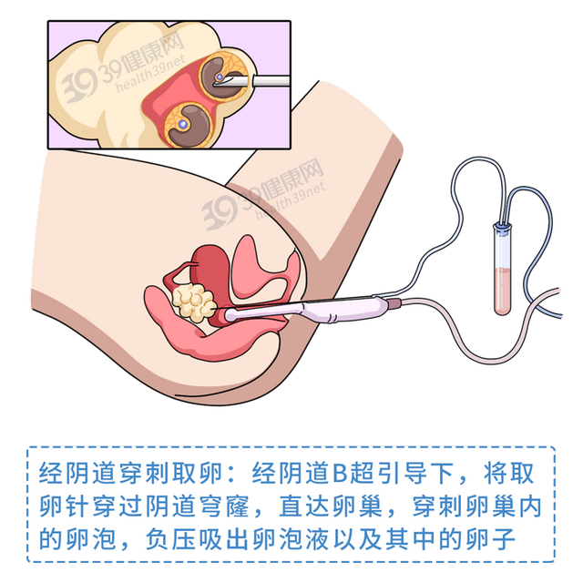 试管婴儿心得 试管婴儿心得