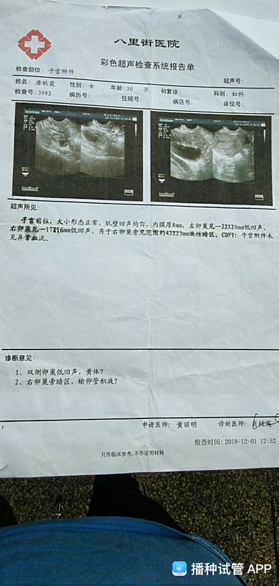 试管婴儿输卵管积水(不处理积水直接做试管)