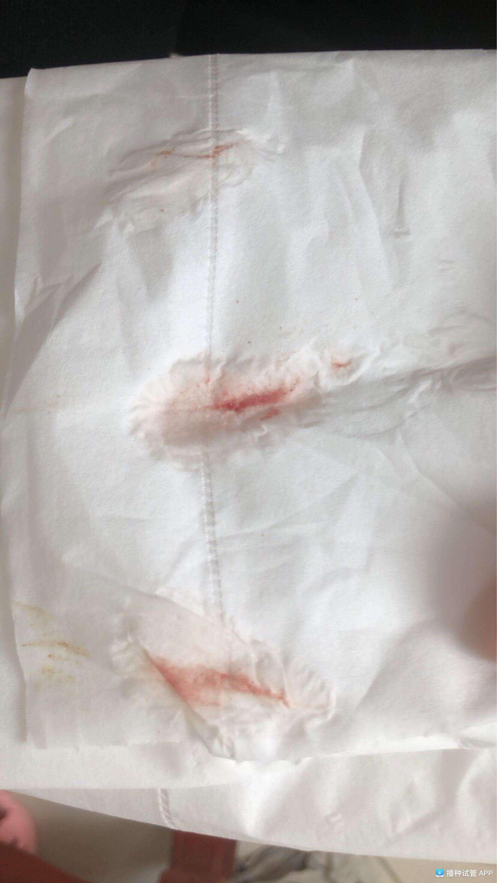 试管婴儿流血试管婴儿出血怎么回事