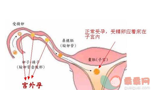 试管婴儿可能宫外孕吗(怀孕一个月有什么反应和现象)