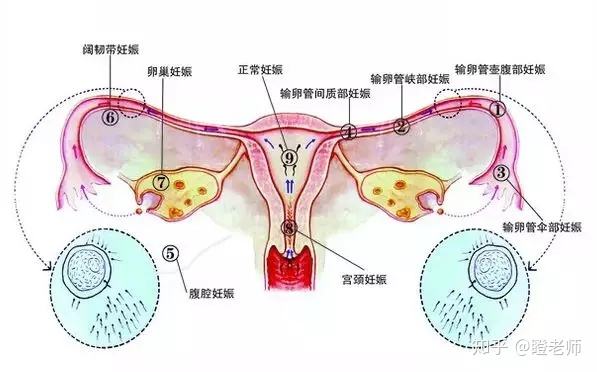 试管婴儿可能宫外孕吗(怀孕一个月有什么反应和现象)