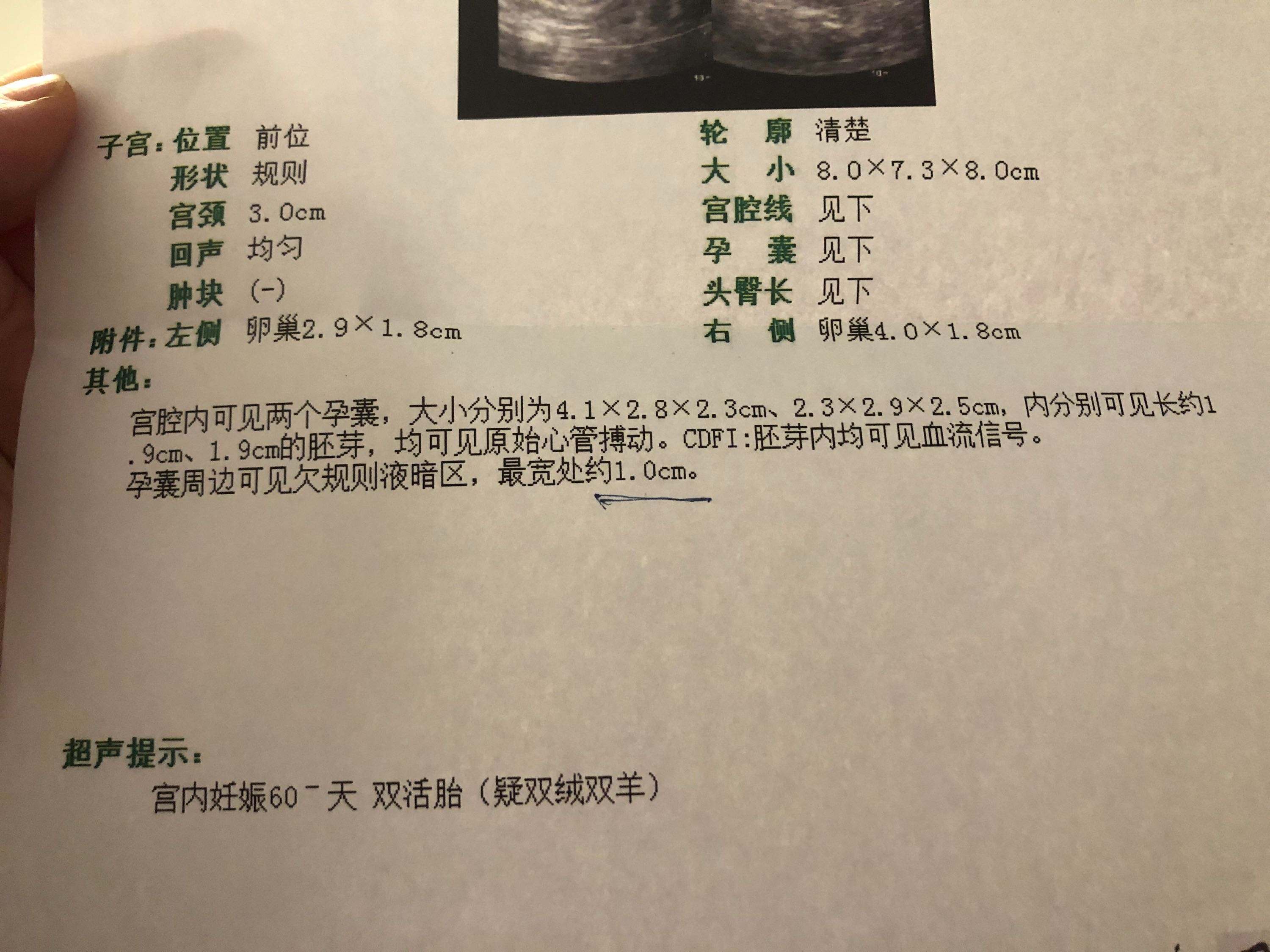 试管婴儿是双胞胎俄罗斯试管婴儿费用