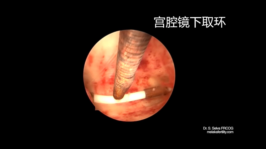 试管婴儿的宫腔镜试管婴儿前做宫腔镜