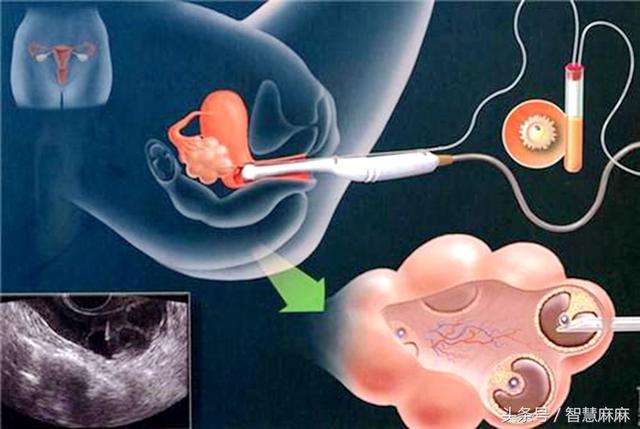 女的做试管婴儿试管婴儿抽精子过程图