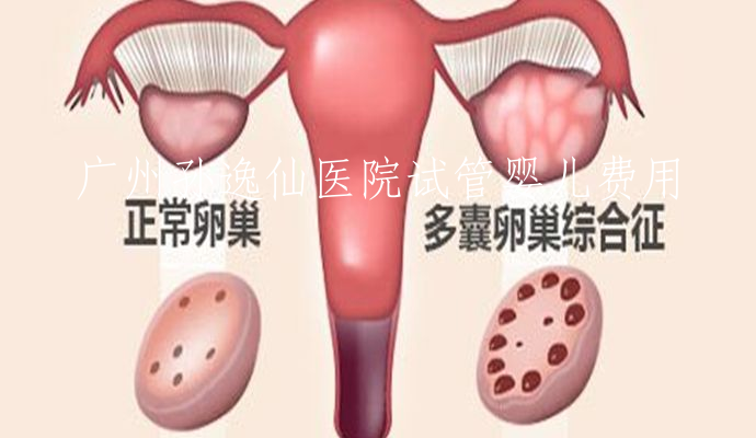 广州孙逸仙医院试管婴儿费用的简单介绍